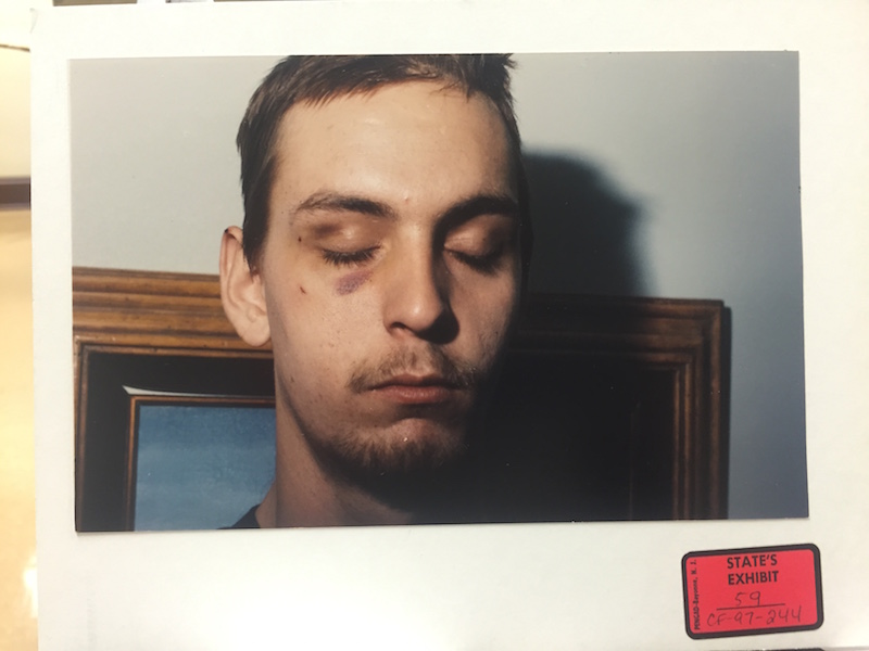 Justin Sneed's black eye from the struggle with Barry Van Treese, from court exhibits. 